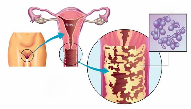 Nhiễm trùng âm đạo là một trong những nguyên nhân gây đi tiểu đêm ở nữ